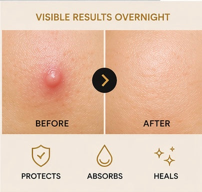 ZeroMark Patch™ – Hydrocolloid Acne Patches